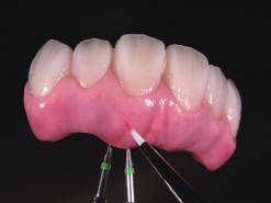 Figura 2: Efectul roşiatic al gingiei se poate obţine la