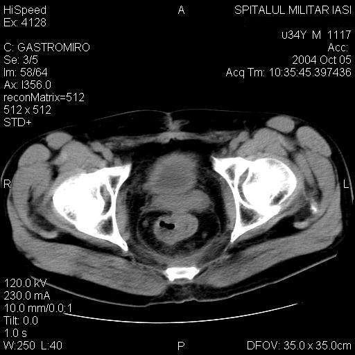 neoplasme metastazează predominant pe o cale particulară, producând imagini caracteristice la CT. Imaginea CT a extensiei peritoneale directe a tumorii depinde de gradul de diseminare.