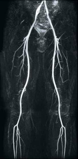 CIA: Contrast-free Improved Angiography Superior imaging of smaller vessels to expand the window of opportunity for evaluating early disease
