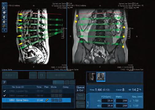 EasyTech technology helps you improve workflow with automatic slice alignment for cardiac, neuro and spine exams, standardizing your