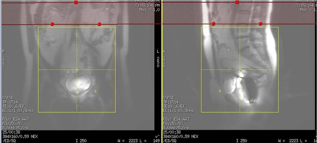 Aortic bifurcation Save Series Scan After the Ax T1 3D images appear, check to see if the endorectal coil is