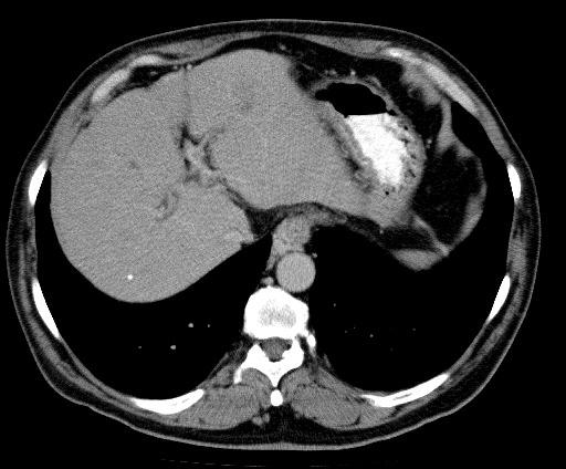 CT HCC in cirrhosis MSCT,