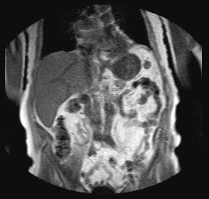 MRI of the liver Start