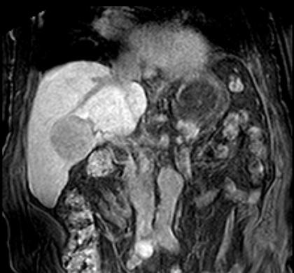 Scan 8 (Hepatobiliary Phase) 3D T1 w gradient echo,