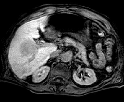Scan 9 (Hepatobiliary Phase) 3D T1 w gradient echo,