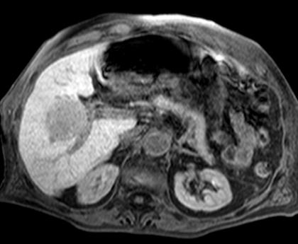 Scan 10 (Hepatobiliary Phase) 2D T1 w gradient echo,