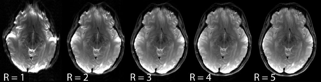 Example of EPI with parallel imaging (Different parallel imaging