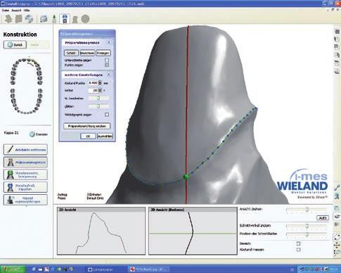Crowns, bridges, telescopic work and abutments For each material, the software suggests the best design features (such as the wall thickness of a