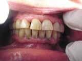 S-au asociat pierderea osoasă rapidă şi multiple abcese paro dontale. Formele severe ale bolii parodontale au fost întâlnite la pacienţii diabetici decompensaţi şi cu o stare precară a igienei orale.