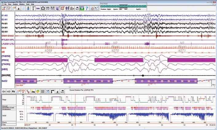 Grass Comet-PLUS PSG TWin PSG Flexible, easy-to-use software Many years of dedication to the field of sleep diagnostics has allowed Grass to develop a software platform that is easy to use, yet