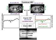 Karla, Automatic Exposure Control in Multidetector-row CT TCM Modulations Angular + Longitudinal (x, y, z direction) Is an AEC feature that incorporates the properties of