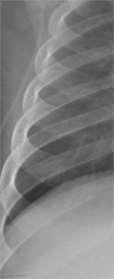 -0,71 34,57 µgy Radiologist to decide contrast ribs/pulmo