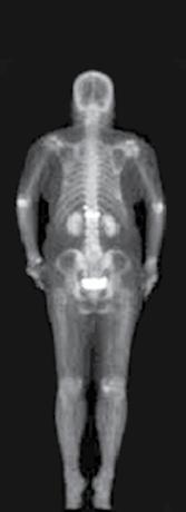 Articole de specialitate Fractura-tasare vertebrală osteoporotică vs metastatică diagnostic diferenţial multidisciplinar medicină nucleară şi radiologie Fracturile şi complicaţiile acestora