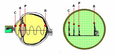 time the sound beam encounters an interface. The greater the acoustic mismatch, the greater the amplitude of the returning echo. A-mode of the human eye.