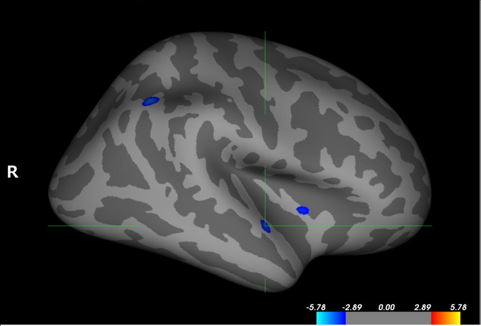 bilateral auditory cortex and the right anterior insula