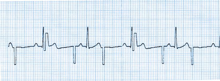 Pacing/Cardioversion Examples of paced rhythms Pacing 1. Place OneStep Pacing or OneStep Complete Electrodes on patient.