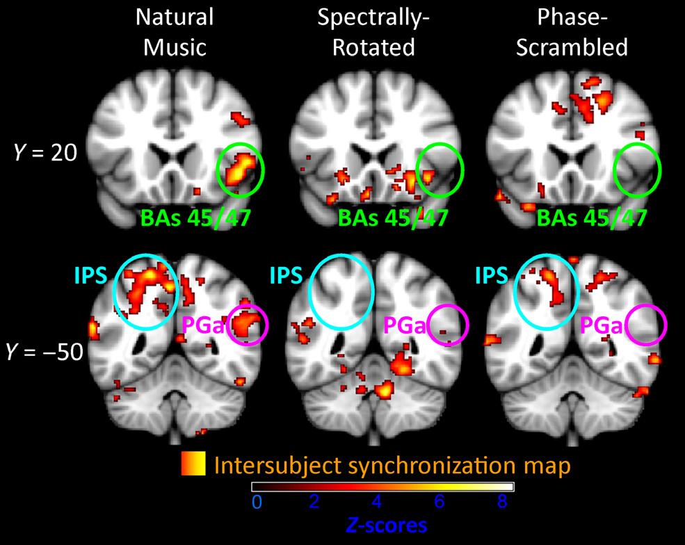 Results indicate ISS throughout auditory cortex, including Heschl s gyrus (HG, blue), planum temporale (PT, cyan), posterior superior temporal gyrus (pstg, pink), and planum polare (PP, green), for