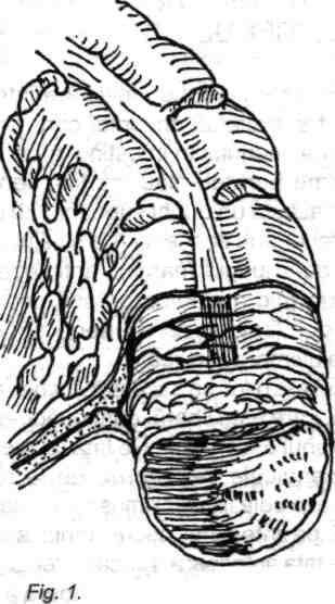Anatomia chirurgicală a colonului, apendicelui, rectului şi canalului anal 13 inserţiei omentului mare, situată anterior şi tenia liberăîn poziţie inferioară sau posteroinferioară.