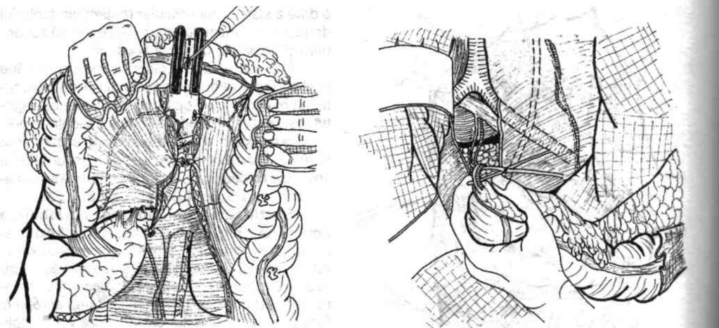 100 Chirurgia colonului, rectului şi canalului anal Fig. 4,127- Nivelul probabil al secţiunii colonice craniale, pe colonul transvers.