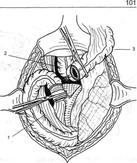 Chirurgia de exereză conservatoare colorectală drept şi chiar a colonului drept parţial (fig. 4.129 a.).