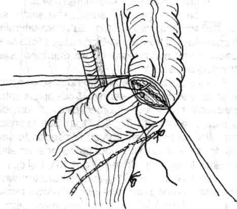 102 Chirurgia colonului, rectului şi canalului anal Fig. 4.131 - a -Anastomoza manuală colorectală executată latero-terminal cu fire separate neresorbabile; b - Continuare la fig. 131 a.