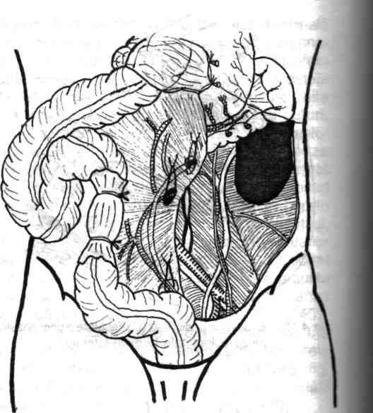 106 Chirurgia colonului, rectului şi canalului anal Fig. 4.141 - Dirijarea ansei colonice anastomotice în pelvis, spre capătul sigmoidorectal transmezenteric.