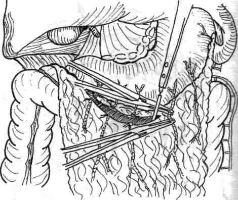108 Chirurgia colonului, rectului şi canalului anal colonului transvers (fig. 4.4).