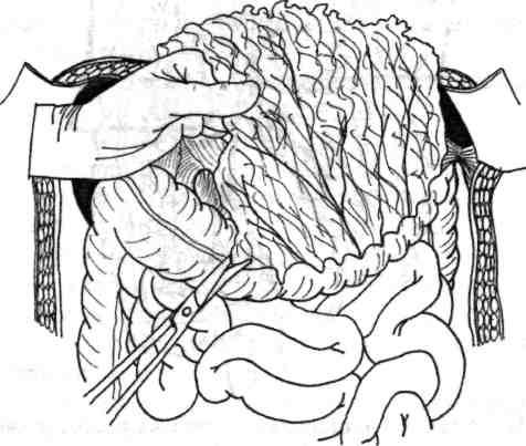Intestinul subţire este deplasat caudal sau în raport cu mersul operaţiei spre colonul drept sau stâng.