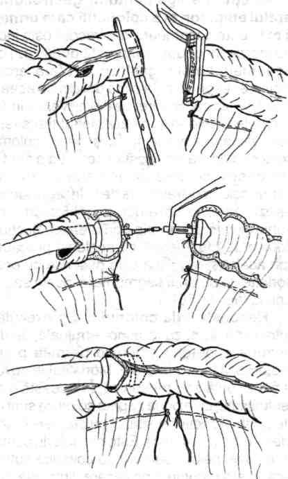 Chirurgia colonului, rectului şi canalului anal Anastomoza termino-terminală se execută cu un stapler circular adecvat dimensional (fig. 4.158,4.159,4.160).