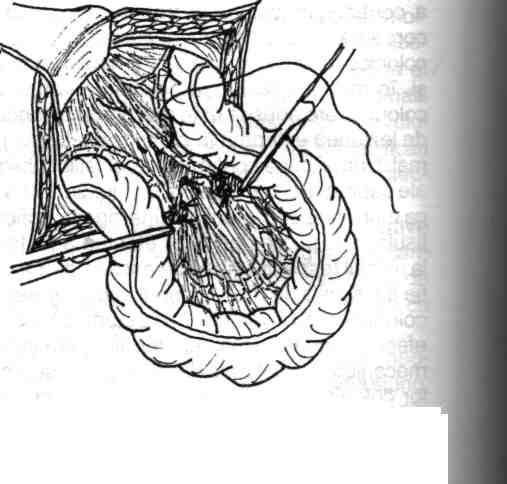 116 Chirurgia colonului, rectului şi canalului anal Fig. Fig. 4.