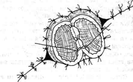 două picioare ale ansei colonice între marginile de sutură şi aplicându-se câteva puncte de sutură peritoneu-ansă (fig. 4.165).