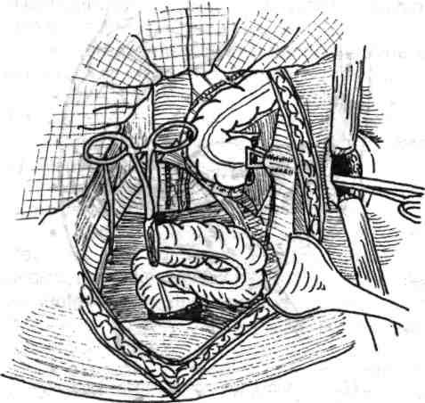 Chirurgia de exereză conservatoare colorectală tjtft este mai jos plasată, ceea ce a impus şi o mobilizare corespunzătoare a rectului, drenajului clasic abdominal, cu tuburi de dren exteriorizate