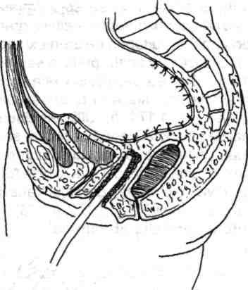 120 Chirurgia colonului, rectului şi canalului anal Fig. 4.