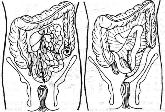 Chirurgia colonului, rectului şi canalului anal Dezinsertia colostomei. Se efectuează de preferinţă cu o mică masă de instrumente proprie acestui timp operator.