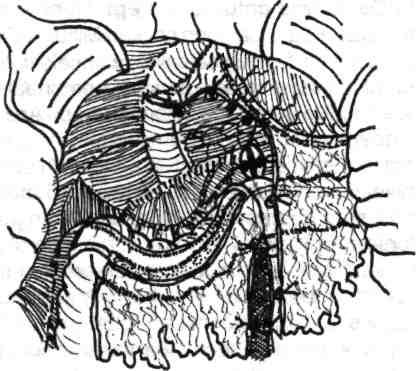 Chirurgia colonului, rectului şi canalului anal Fig. 4.179 - Eliberarea unghiului drept al colonului 