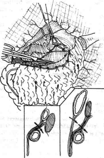 m Fig. 4.180- Decolarea şi eliberarea colonului transvers. care incizarea lor se efectuează succesiv, întâi marele epiploon şi apoi mezocolonul.