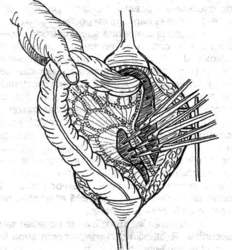 Decolarea colonului descendent se face prin incizia peritoneului parieto-colic stâng până la nivelul mezocolonului sigmoidian.
