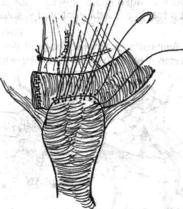 ansele ce urmează a fi anastomozate. Fig. 4.189 - Executarea suturii stratului total posterior al anastomozei, manual cu fire separate.