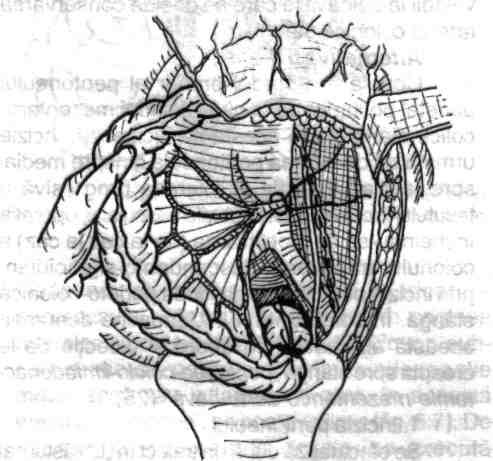 Chirurgia de exereză rectală (colorectală) splenic al colonului, de-a lungul firidei parietocolonice stângi, manevră efectuată deci în sens caudo-cranial (fig. 4.121). 2.