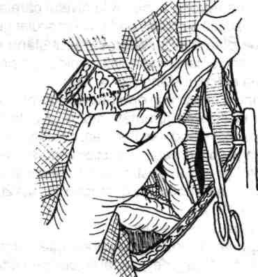 136 Chirurgia colonului, rectului şi canalului anal Fig. 5.3 - Decolarea colonului stâng prin incizia peritoneului în firida parietocolonică stângă.