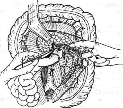 Chirurgia de exereză rectală (colorectală) 137 Fig. 5.5 - Incizia peritoneului parietoabdominal posterior, incizia având forma literei L" răsturnat. Fig. 5.7 - Disecţia-exereză a limfonodulilor sub- şi retropancreatici la nivelul unghiului Treitz.
