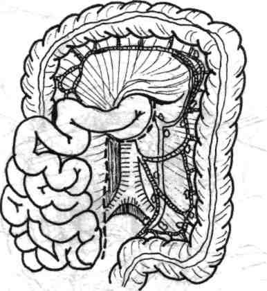 începându-se la nivelul marginii inferioare a pancreasului, continuată caudal spre originea arterelor iliace primitive (fig. 5.6).