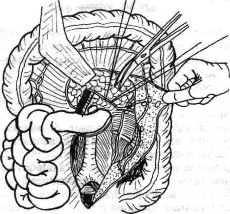 8- Ligatura-secţiunea arterei mezenterice inferioare şi continuarea disecţiei caudal, dincolo de bifurcaţia arterei aorte, spre escavatia sacrată. stânga (fig. 5.