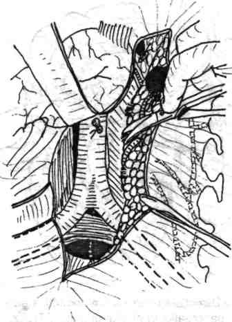 138 Chirurgia colonului, rectului şi canalului anal Fig. 5.9- Continuare la figura 5.8. Disecţia retroperitoneală de la dreapta spre stânga, până la apariţia fibrelor psoasului. B.