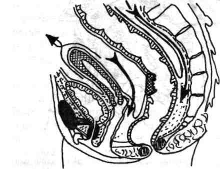 140 Chirurgia colonului, rectului şi canalului a, trebuie continuată cu foarfecă curbă, boantă, pe o distanţă variabilă în sens caudal, dar cât mai aproape de acelaşi planşeu al ridicătorilor anali.