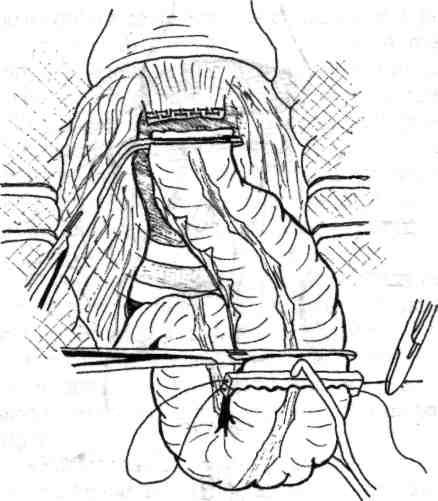 142 Chirurgia colonului, rectului şi canalului anal Fig. 5.18 - Bontul rectal pregătit în vederea anastomozei de restabilire ulterioară.