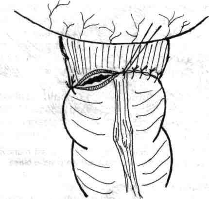 Chirurgia de exereză rectală (colorectală) 143 Fig. 5.21 - Exteriorizarea mandrenului piesei principale a sfap/er-ului condus în bontul rectal. Fig. 5.19- Sutura manuală a planului total anterior (nodurile rămân în afara lumenului colorectal).