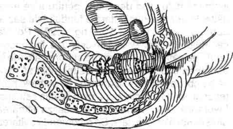 Chirurgia colonului, rectului şi canalului ai Fig. 5.22 - Cuplarea intraabdominală a componentelor s/ap/er-ului. Fig. 5.24 - Continuare la fig. 5.23.