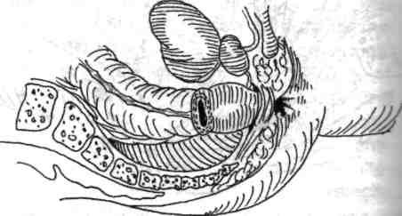 Odată poziţia tijei sfap/er-ului aleasă şi fixată, chirurgul din echipa perineală exteriorizează progresiv mandrenul, prin mişcări lente de înşurubare ale piesei rotative a