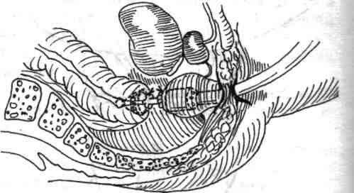 23), după care cele două capete digestive de anastomozat se apropie progresiv cu şi prin \ acelaşi mecanism de înşurubare al mecanismului tijei principale a sfap/erului